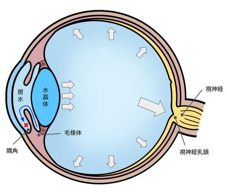 緑内障の説明イラスト