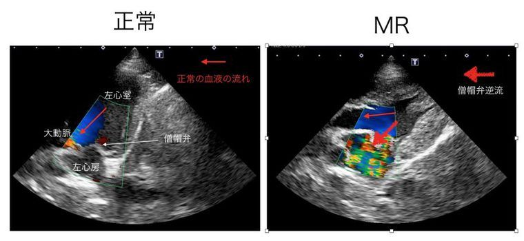 正常な心臓と僧帽弁閉鎖不全症の超音波画像